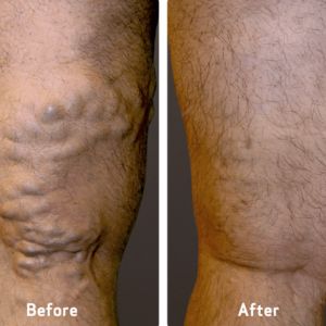 Does Red Light Therapy Work for Varicose Veins? 2 Before and After