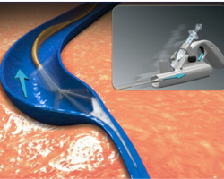 Clarivein treatment for veins