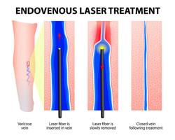 EVLT (EVLA) Vein Treatment