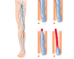 Radiofrequency Ablation (RFA) vein treatment