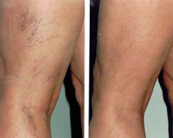 Sclerotherapy for Spider Veins