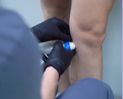 Ultrasound-Guided Sclerotherapy for vein treatment