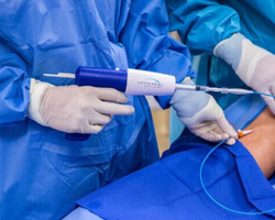 Venaseal Vein Treatment