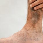What Causes Venous Ulcers and How to Prevent Them