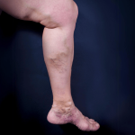 Areas of the Body that Develop Spider Veins