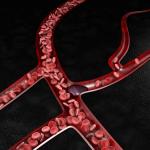 Blood Clot and varicose veins