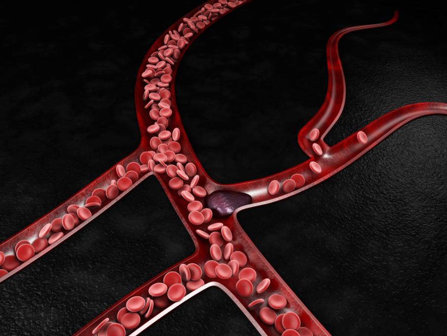 Blood Clot and varicose veins