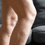 Causes Lack of Circulation