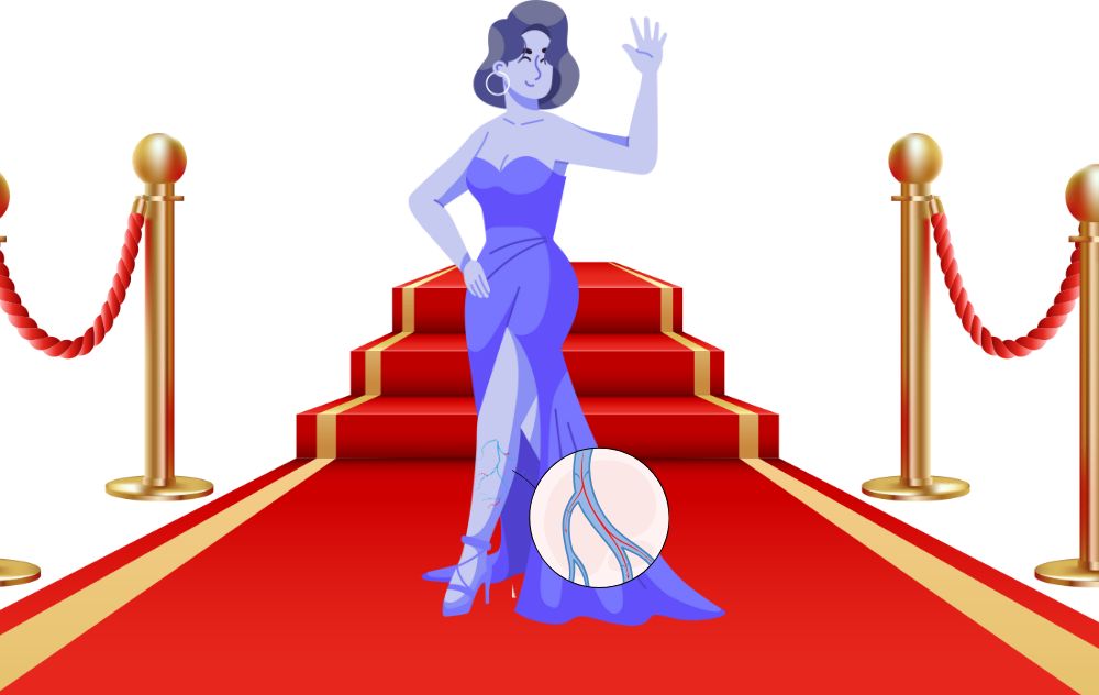 Celebrities with Varicose Veins
