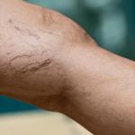 Spider Veins on a Young Adult