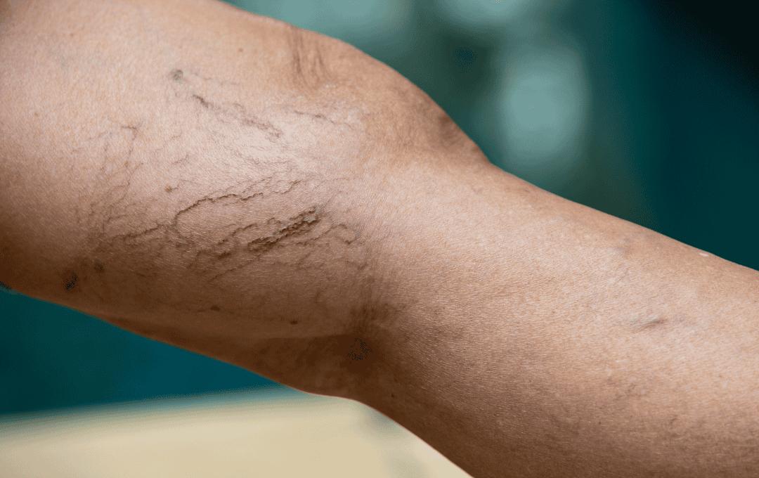 Spider Veins on a Young Adult