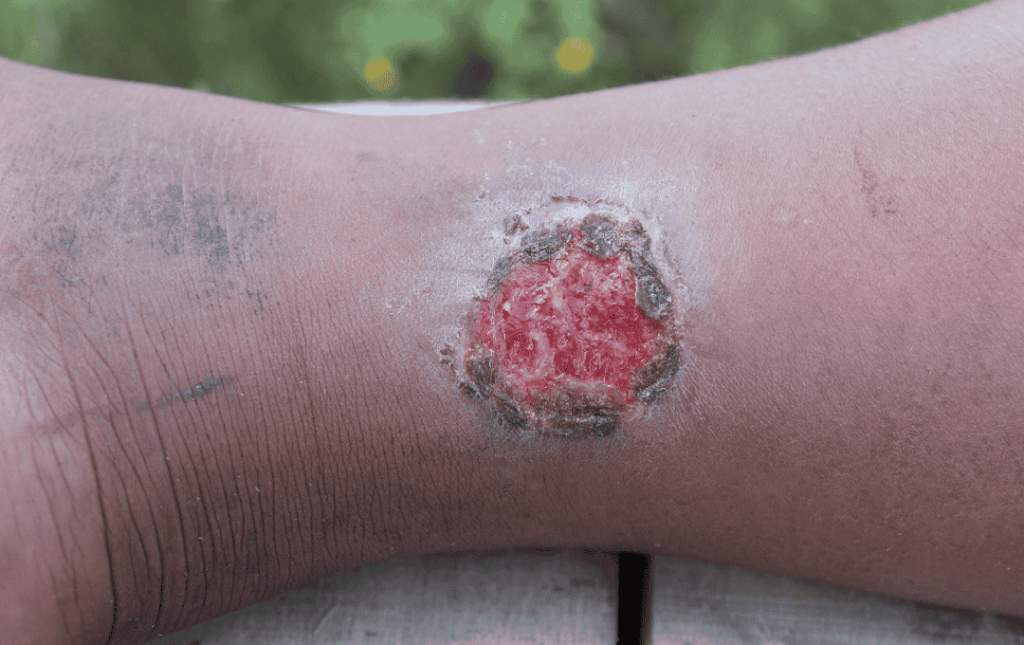 What Causes Venous Ulcers and How Do You Treat Them