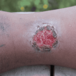 What Causes Venous Ulcers and How Do You Treat Them