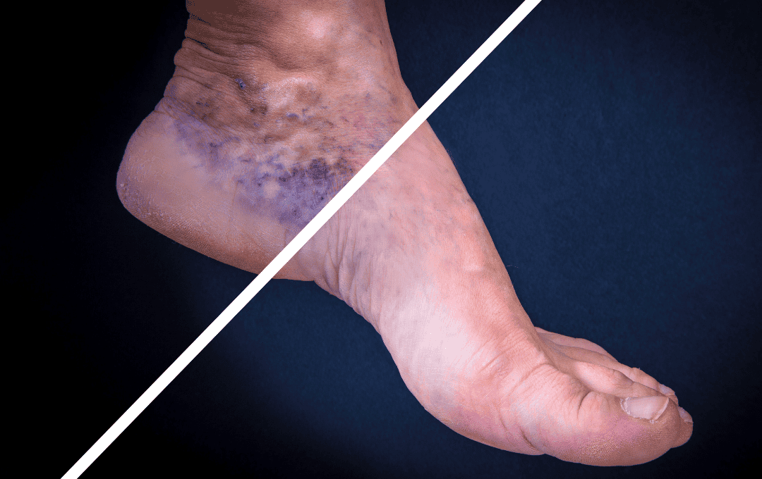Are Varicose Veins Always Visible?