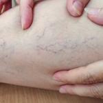 What Age Do You Get Reticular Veins?