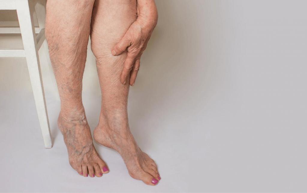 Areas of the Body that Develop Spider Veins