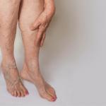 Areas of the Body that Develop Spider Veins