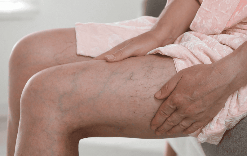 Someone with visible veins in legs