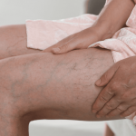 Someone with visible veins in legs