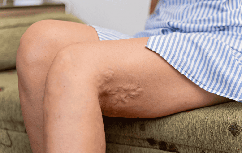 Varicose Veins and are they a sign of poor health