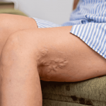 Varicose Veins and are they a sign of poor health