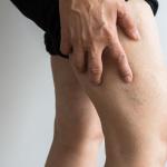 Looking at spider veins after exercise