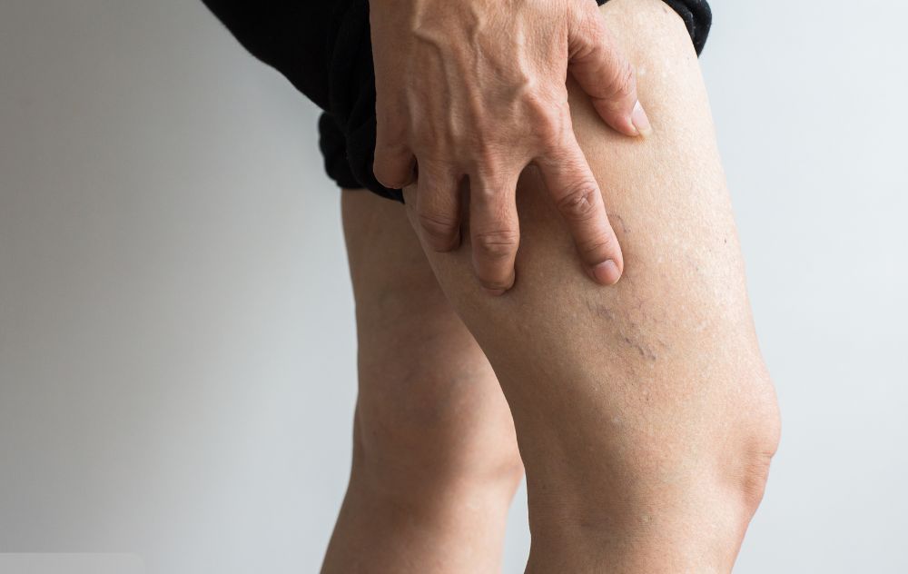 Can Exercise Make Spider Veins Worse? 1 Looking at spider veins after exercise