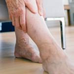 Itchy Legs Due to Varicose Veins