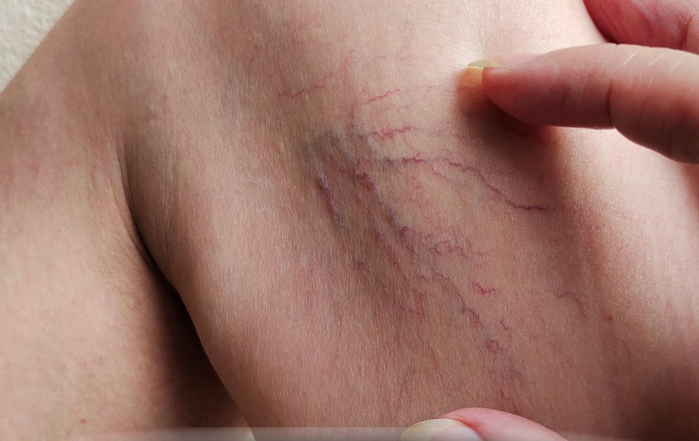Wondering if water can cause spider veins