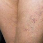 Looking at legs wondering what causes veins to show
