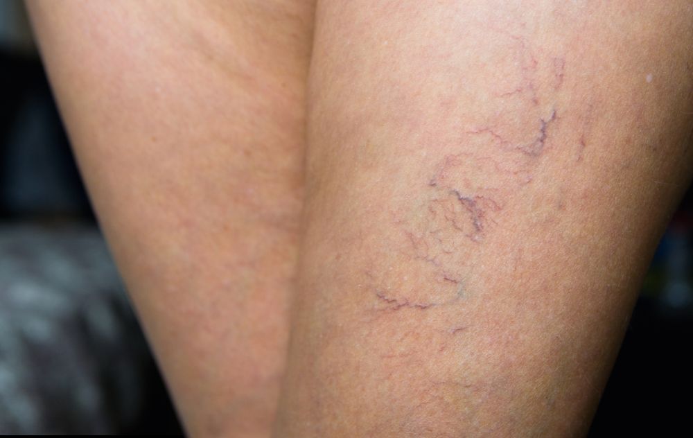 Looking at legs wondering what causes veins to show