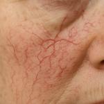 Spider Veins on Face