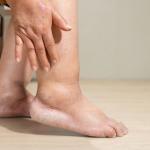Vein Disease common symptom heavy legs and edema