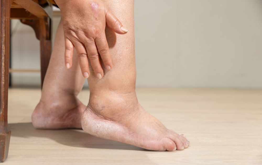 Vein Disease common symptom heavy legs and edema