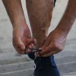 Varicose Veins Common