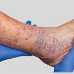 Do Spider Veins Mean Poor Circulation?