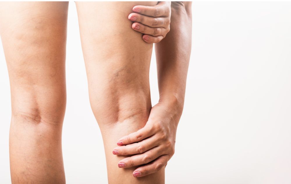 What Age Do Varicose Veins Appear?