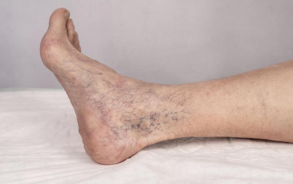 Reticular Veins Hero