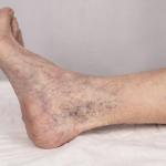Reticular Veins Hero