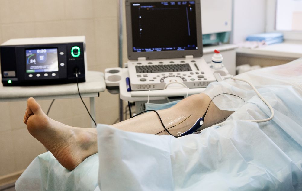 Varicose Vein Study dementia