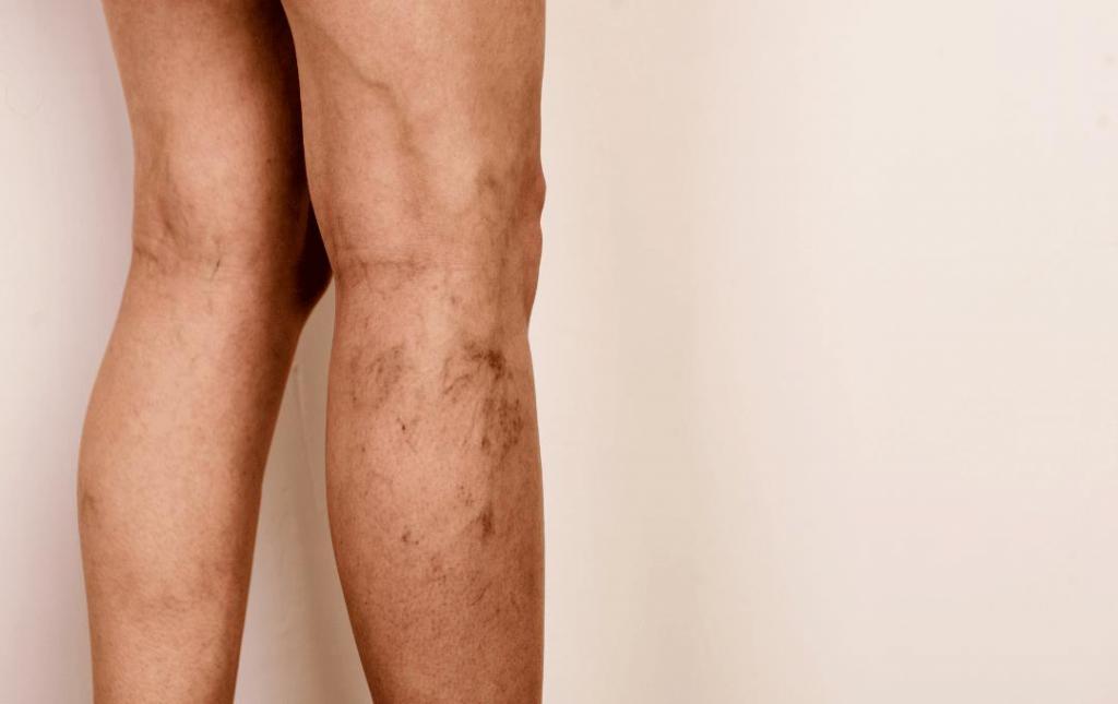 Calves that have varicose veins