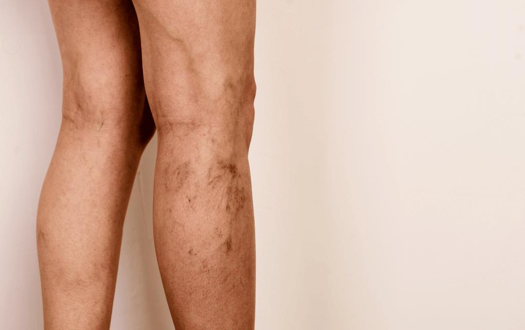 Calves that have varicose veins