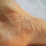 bulging ankle veins