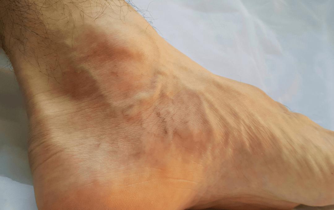 bulging ankle veins