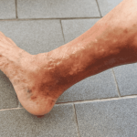 Leg with a Burst Vein