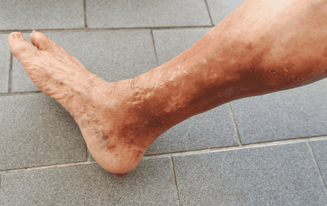 Leg with a Burst Vein