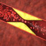 A Blood Clot in the leg