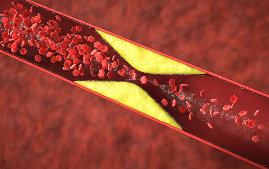 A Blood Clot in the leg