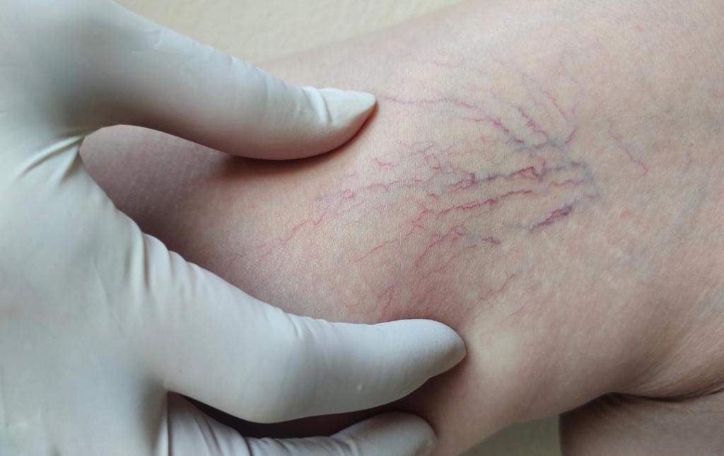 Spider Veins on Leg