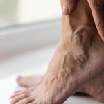 sudden bulging veins on feet